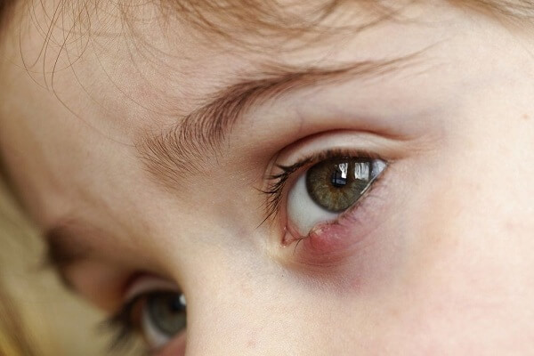 8 Mẹo chữa lẹo mắt hiệu quả được các bác sĩ nhãn khoa chứng nhận