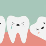 Giá nhổ răng khôn có đắt không? Có nên nhổ răng khôn không?