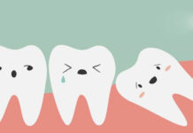 Giá nhổ răng khôn có đắt không? Có nên nhổ răng khôn không?