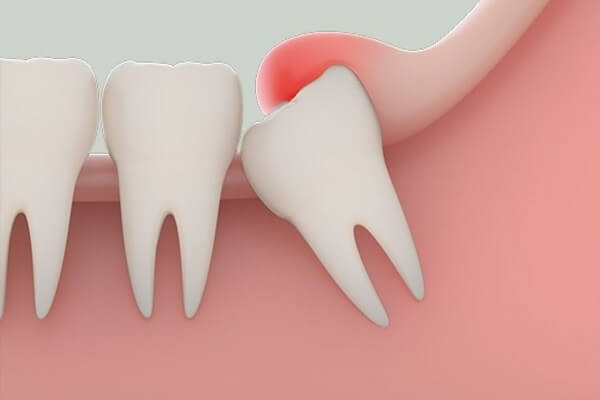 Giá nhổ răng khôn tùy thuộc vào nhiều yếu tố